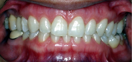 ホワイトニング